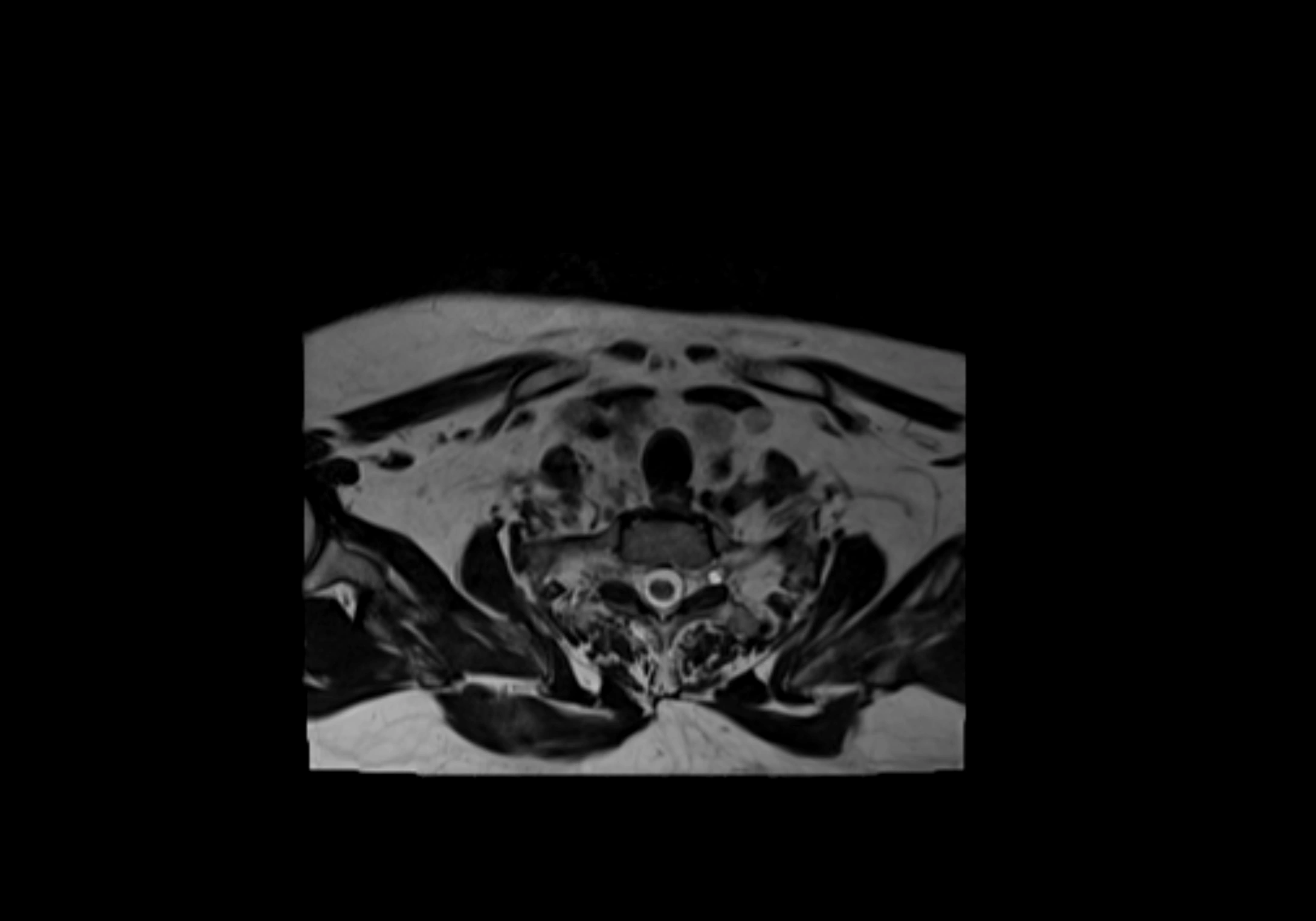 Neck axial  lymph node cross sectional MRI anatomy 3T MRI  image-img-00001-00090.webp